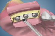 Ridge Splitting-Standard Instrumnets with Membrane